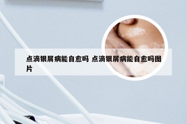 点滴银屑病能自愈吗 点滴银屑病能自愈吗图片