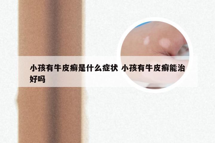小孩有牛皮癣是什么症状 小孩有牛皮癣能治好吗