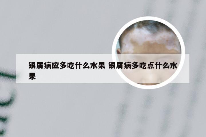银屑病应多吃什么水果 银屑病多吃点什么水果