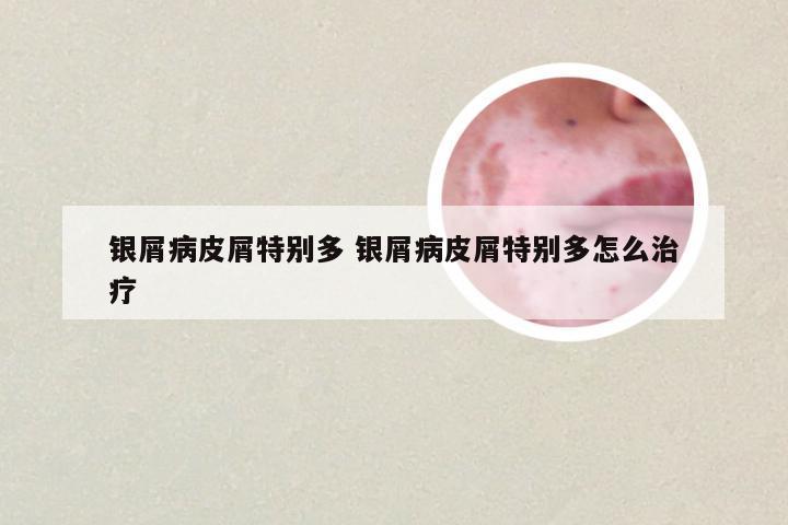 银屑病皮屑特别多 银屑病皮屑特别多怎么治疗