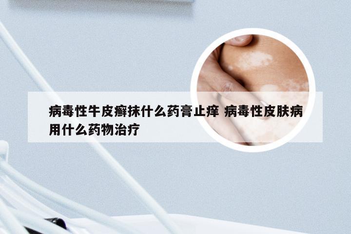 病毒性牛皮癣抹什么药膏止痒 病毒性皮肤病用什么药物治疗