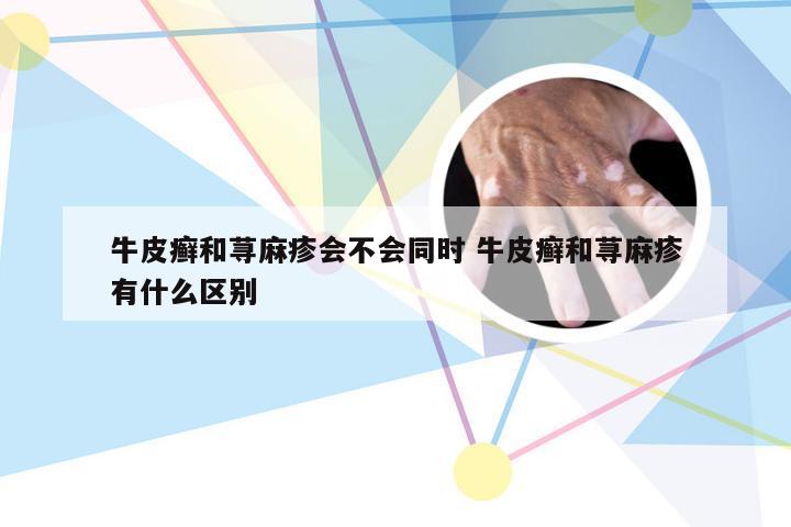 牛皮癣和荨麻疹会不会同时 牛皮癣和荨麻疹有什么区别