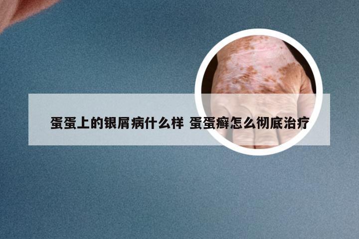 蛋蛋上的银屑病什么样 蛋蛋癣怎么彻底治疗