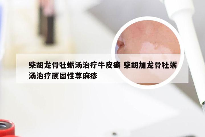 柴胡龙骨牡蛎汤治疗牛皮癣 柴胡加龙骨牡蛎汤治疗顽固性荨麻疹