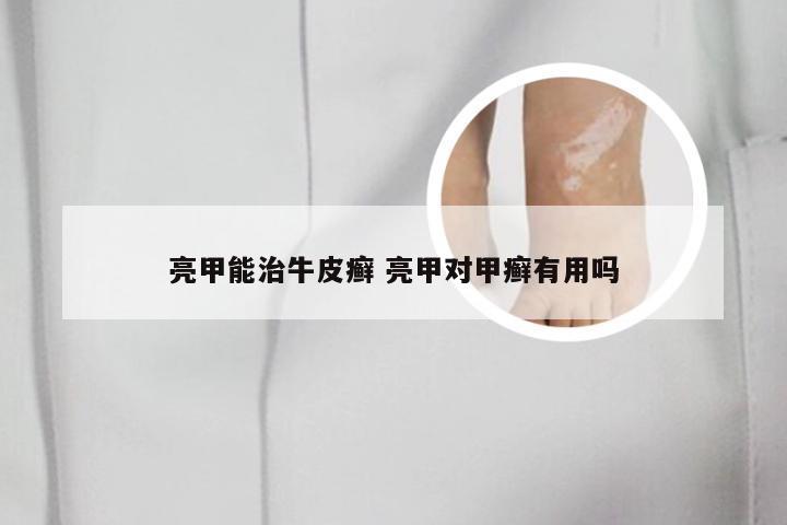 亮甲能治牛皮癣 亮甲对甲癣有用吗