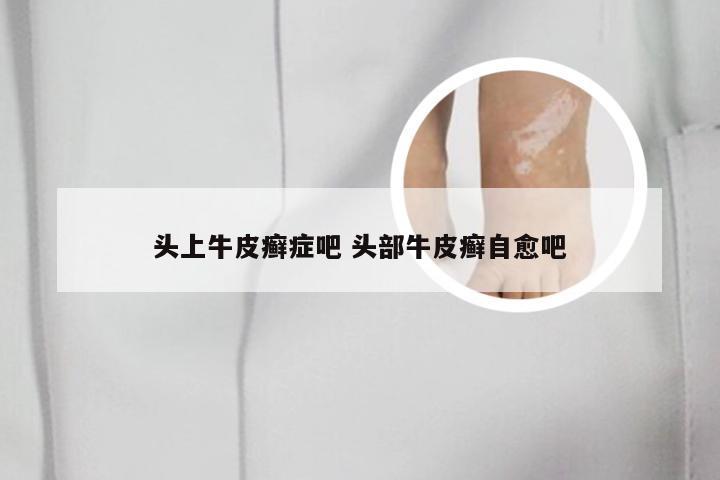头上牛皮癣症吧 头部牛皮癣自愈吧