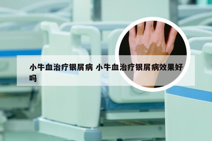 小牛血治疗银屑病 小牛血治疗银屑病效果好吗