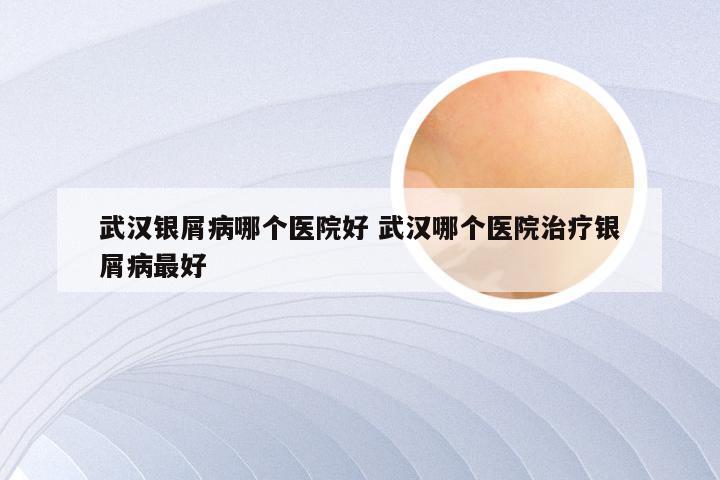 武汉银屑病哪个医院好 武汉哪个医院治疗银屑病最好