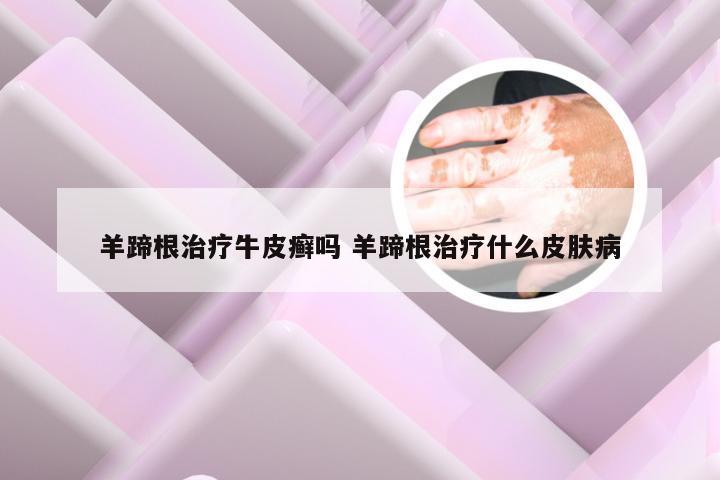 羊蹄根治疗牛皮癣吗 羊蹄根治疗什么皮肤病