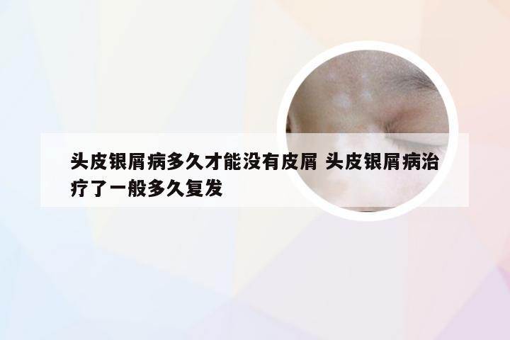 头皮银屑病多久才能没有皮屑 头皮银屑病治疗了一般多久复发