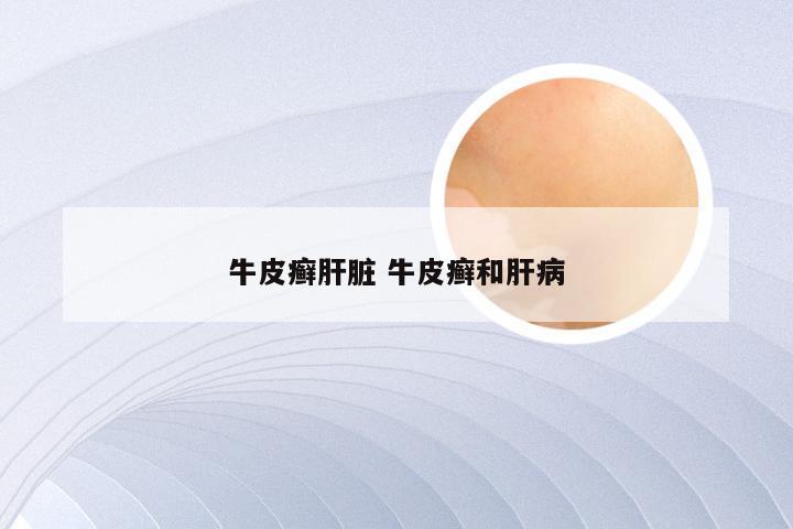 牛皮癣肝脏 牛皮癣和肝病