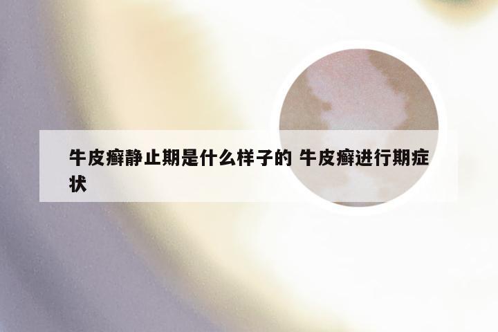 牛皮癣静止期是什么样子的 牛皮癣进行期症状