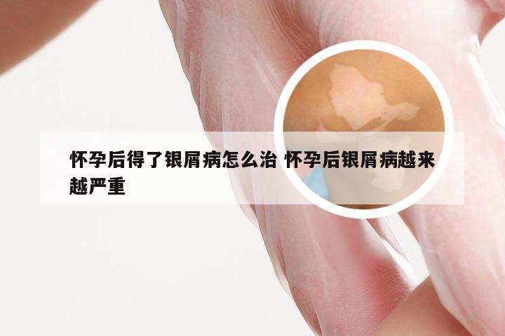 怀孕后得了银屑病怎么治 怀孕后银屑病越来越严重