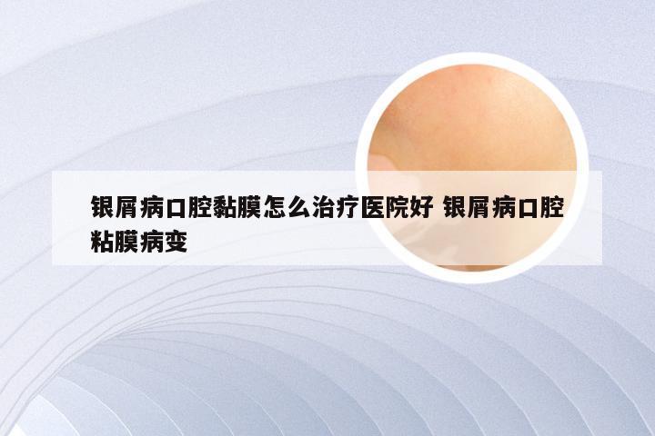 银屑病口腔黏膜怎么治疗医院好 银屑病口腔粘膜病变