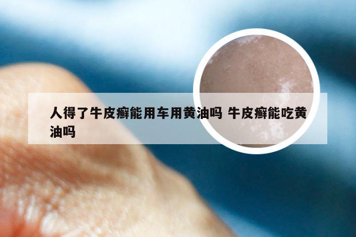 人得了牛皮癣能用车用黄油吗 牛皮癣能吃黄油吗