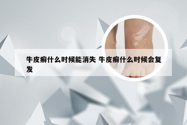 牛皮癣什么时候能消失 牛皮癣什么时候会复发