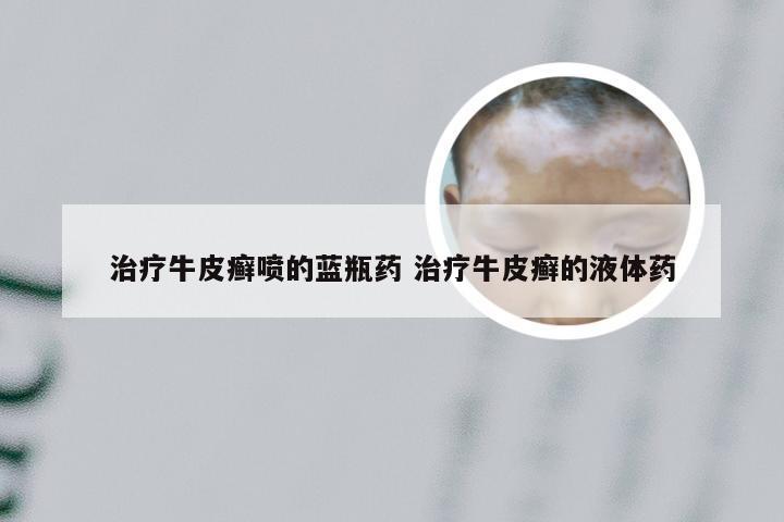 治疗牛皮癣喷的蓝瓶药 治疗牛皮癣的液体药