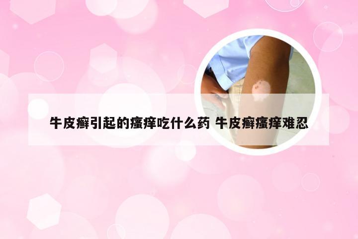 牛皮癣引起的瘙痒吃什么药 牛皮癣瘙痒难忍