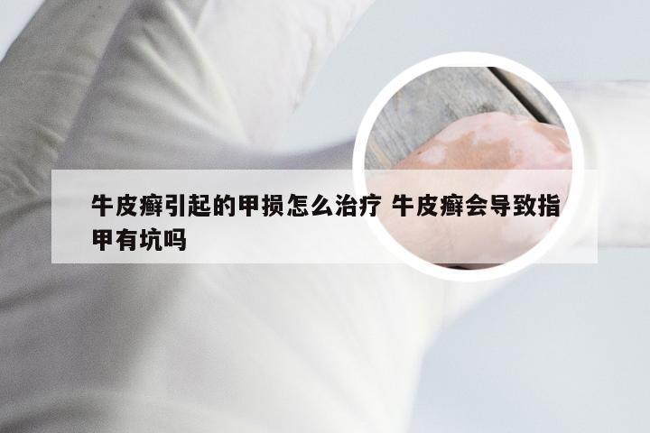 牛皮癣引起的甲损怎么治疗 牛皮癣会导致指甲有坑吗