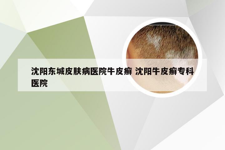 沈阳东城皮肤病医院牛皮癣 沈阳牛皮癣专科医院