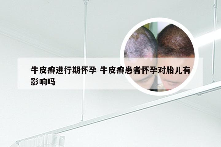 牛皮癣进行期怀孕 牛皮癣患者怀孕对胎儿有影响吗
