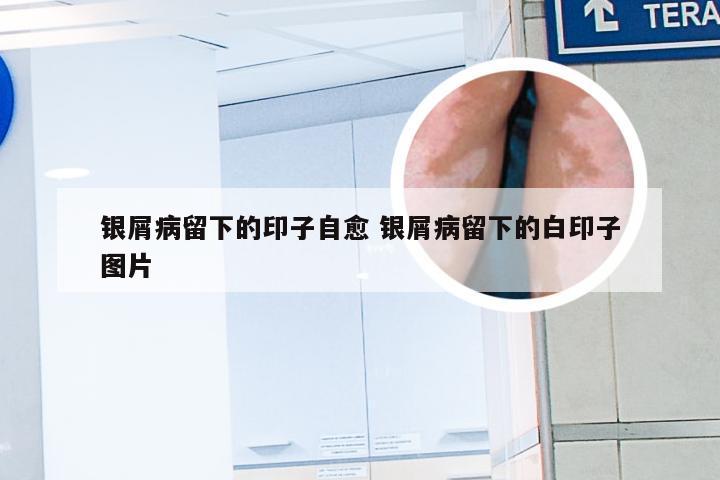 银屑病留下的印子自愈 银屑病留下的白印子图片