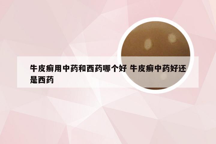 牛皮癣用中药和西药哪个好 牛皮癣中药好还是西药