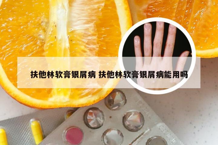 扶他林软膏银屑病 扶他林软膏银屑病能用吗