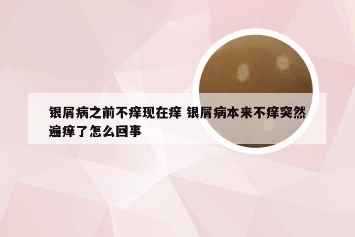 银屑病之前不痒现在痒 银屑病本来不痒突然遍痒了怎么回事