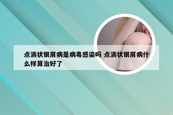 点滴状银屑病是病毒感染吗 点滴状银屑病什么样算治好了