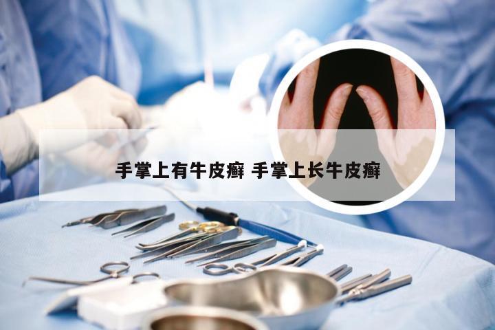 手掌上有牛皮癣 手掌上长牛皮癣