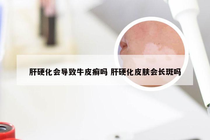 肝硬化会导致牛皮癣吗 肝硬化皮肤会长斑吗