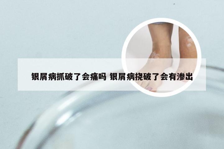 银屑病抓破了会痛吗 银屑病挠破了会有渗出