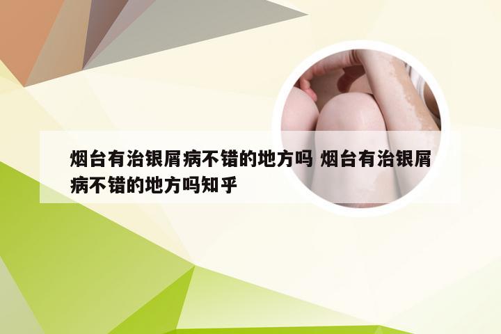 烟台有治银屑病不错的地方吗 烟台有治银屑病不错的地方吗知乎