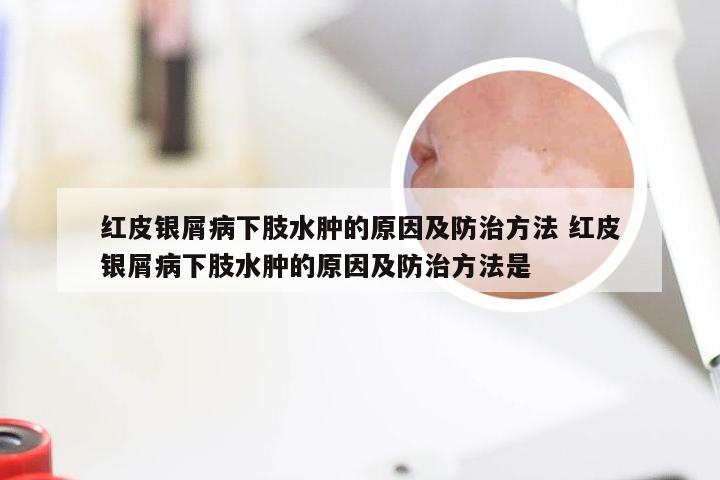 红皮银屑病下肢水肿的原因及防治方法 红皮银屑病下肢水肿的原因及防治方法是