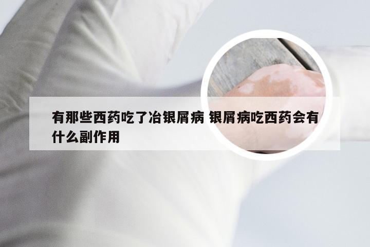 有那些西药吃了冶银屑病 银屑病吃西药会有什么副作用