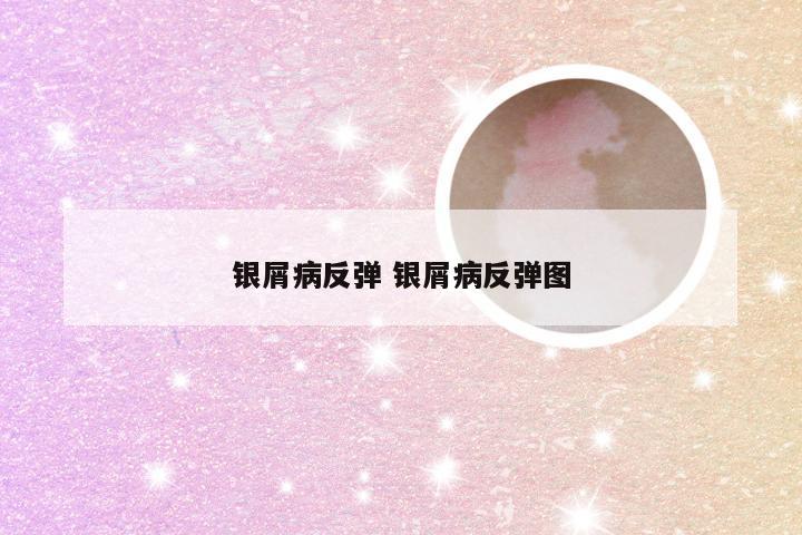 银屑病反弹 银屑病反弹图