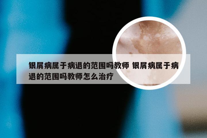 银屑病属于病退的范围吗教师 银屑病属于病退的范围吗教师怎么治疗
