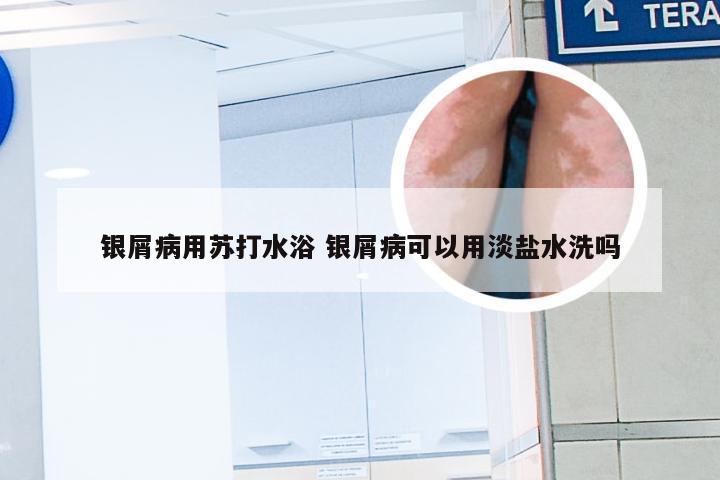银屑病用苏打水浴 银屑病可以用淡盐水洗吗