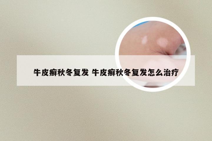 牛皮癣秋冬复发 牛皮癣秋冬复发怎么治疗
