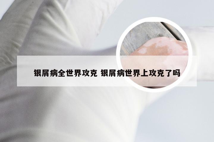 银屑病全世界攻克 银屑病世界上攻克了吗