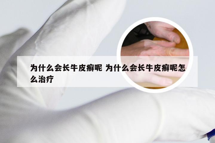 为什么会长牛皮癣呢 为什么会长牛皮癣呢怎么治疗