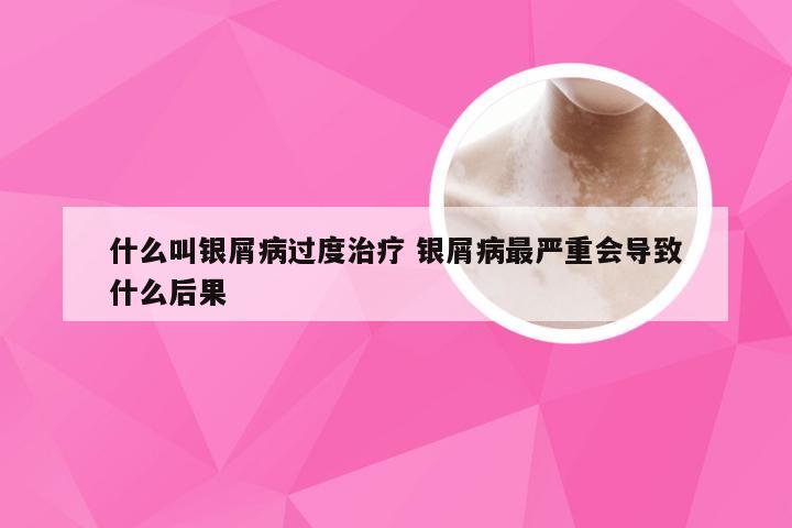 什么叫银屑病过度治疗 银屑病最严重会导致什么后果