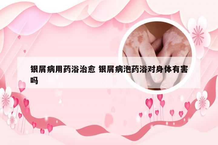 银屑病用药浴治愈 银屑病泡药浴对身体有害吗