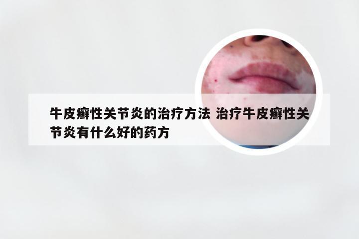 牛皮癣性关节炎的治疗方法 治疗牛皮癣性关节炎有什么好的药方