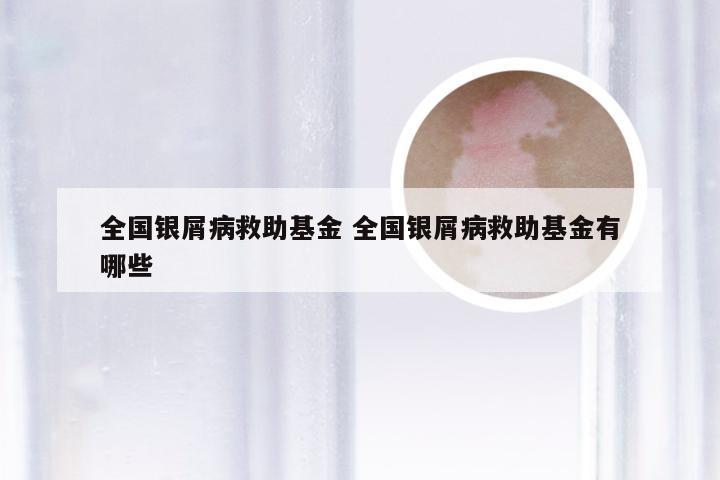 全国银屑病救助基金 全国银屑病救助基金有哪些