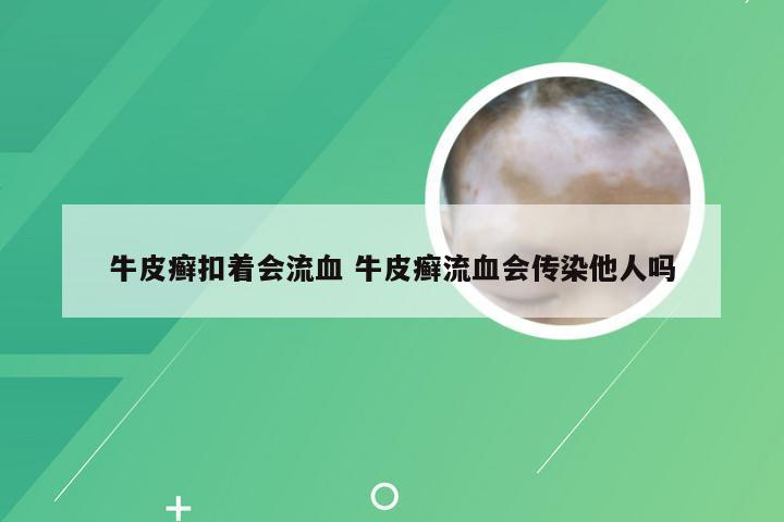 牛皮癣扣着会流血 牛皮癣流血会传染他人吗