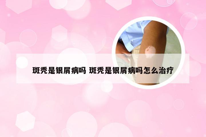 斑秃是银屑病吗 斑秃是银屑病吗怎么治疗