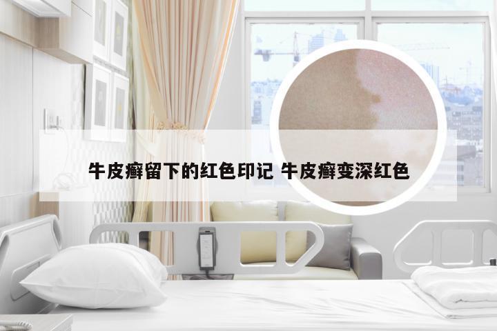 牛皮癣留下的红色印记 牛皮癣变深红色