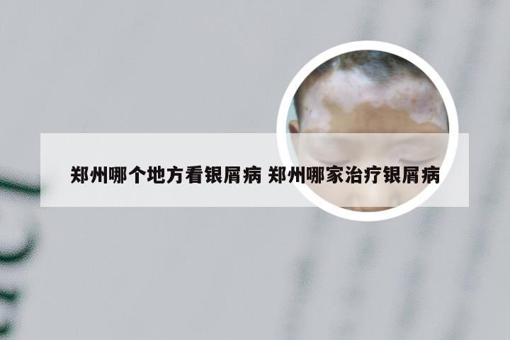 郑州哪个地方看银屑病 郑州哪家治疗银屑病